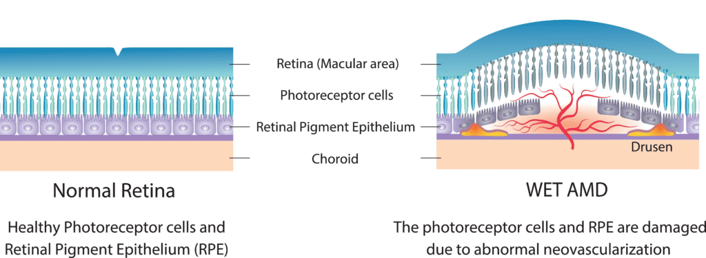 Illustration of a normal retina, and a retina damaged by wet macular degeneration. 