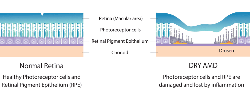 Illustration of normal retina vs retina damaged by drusen and inflammation in dry macular degeneration. 